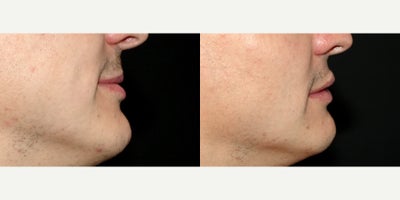 34 year old man treated with Lip Implants - 34 year old man treated with Lip Implants. Photos depict before and 1 month after surgery.