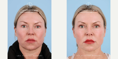 Woman treated with Facelift - Woman treated with Facelift