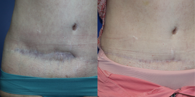 59-year-old woman treated with a Tummy Tuck Revision - Revision of tummy tuck scar revision