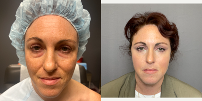 35-44 year old woman treated with Eyelid Surgery, TCA Peel - Lower Lid Bleph + TCA Butterfly Peel
