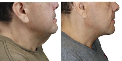 Man treated with Neck Lift - Man treated with Neck Lift