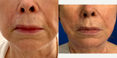 65-74 year old woman treated with Contour Thread Lift - Mint thread lift (pdo) threads lift, contour and shape the cheeks, jowls and neck.