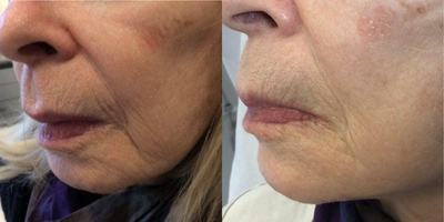 75 and up year old woman treated with Infini RF - This is a 79 year old woman who had a series of 3 monthly Microneedling with Radiofrequency to the lines around the mouth and cheeks. Minimal downtime unlike ablative laser resurfacing. Can be done again in six months.