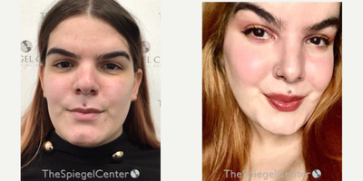 25-34 year old transgender woman treated with Transgender Facial Feminization Surgery - 25-34 year old transgender woman treated with Transgender Facial Feminization Surgery