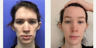 Patient treated with Facial Feminization Surgery, Rhinoplasty, Septoplasty, Transgender Facial Feminization Surgery - 25 to 34 year-old female patient is 4 months post-op from Facial Feminization surgery. Her procedures included: Forehead Lift, Hairline Lowering, Supra Orbital Bone Reduction and Contour, Septorhinoplasty (closed) with Cartilage Grafts and Weirs, Chin Reduction and Contour, Soft Tissue to Nasolabial Folds and Thyroid Cartilage Shave.