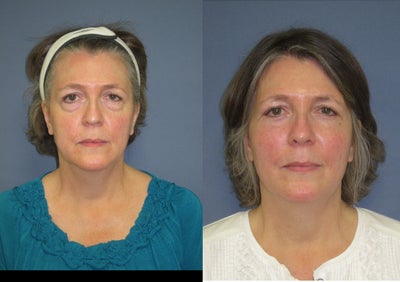 Mid facelift - 
	Age: 50s Diagnosis: Complaints of bags under her eyes, looking tired, and looking older. Surgery: Upper and lower blepharoplasty and a mid face lift.
