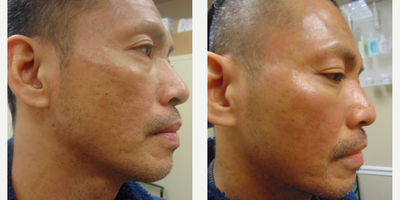 Man treated with Subcision - Man treated with Subcision