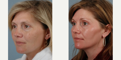 35-44 year old woman treated with Obagi Nu-Derm - 35-44 year old woman treated with Obagi Nu-Derm