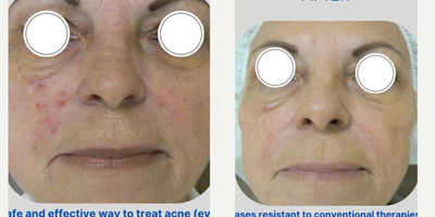 45-54 year old woman treated with Skin Lightening, Skin Rejuvenation, Cyst Removal, Scar Removal, Skin Tightening - Laser acne treatment