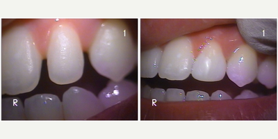 18-24 year old woman treated with Dental Bonding - The patient was unhappy with the size and shape of her incisor and the gaps between it and the adjacent teeth. She wanted a conservative treatment. Happily, we were able to add shape and size to her tooth without removing any tooth structure.