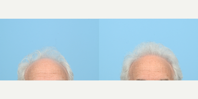 55-64 year old man treated with Hair Transplant, Hair Loss Treatment, PRP for Hair Loss, FUE Hair Transplant, NeoGraft - This 62-year-old received an FUE Hair Transplant by Dr. Wise with 3,010 grafts to the front and top of the scalp to reinforce a receding hairline. He also received PRP therapy on the same day to strengthen the follicles. One year after his surgery, he is happy with the natural-looking results.