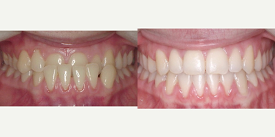 18-24 year old woman treated with Clear Braces - After we fixed this patients underbite, she is able to chew her foods much easier than before.