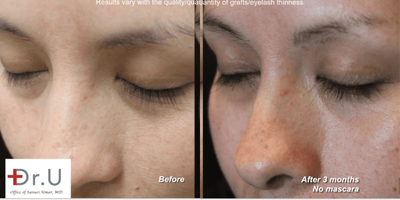 35-44 year old woman Eyelash Transplant using Body Hair / Nape Hair  - Eyelash Transplant Surgery Many people want to know how to get thicker eyelashes without the need for false lashes or extensions. This patient wanted her own naturally growing set of long lashes. She chose to undergo Dr. UGraft's eyelash implant surgery This procedure utilizes special technologyto safely extract donor follicles from anywhere on the body. When it comes to eyelash transplantation, thinner hair that matches real lashes can be harvested from the nape area. The sharp growth angles of this hair type make it amenable to damage using regular Follicular Unit Extraction (FUE) punches. However, the doctor'sDr.UPunch i is intelligently designed with special features that overcome the issue of challenging hair angles. This engineering makes it possible to easily harvest healthy, robust grafts that can grow and thrive long-term in transplanted areas like the lash line. After extracting donor hair from the patients nape, the doctor used this hair to give this patient the thicker, fuller eyelashes that she hoped for. Three months after the procedure for longer eyelashes, the patient reportedher thicker, fuller eyelashes. Additionally, she said that her eyelashes were more even and natural-looking. She started using less mascara and feeling confident about her appearance. Most importantly, (other than the occasional trimming), the patient didnt have to do a lot of maintenance to achieve her desired appearance.