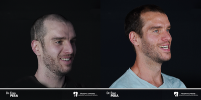 25-34 year old man treated with Jaw Surgery, Genioplasty, V Line Surgery - Orthognathic surgery For Sleep Apnea ( lefort 1 osteotomy, Sagittal split ramus osteotomy, genioplasty)