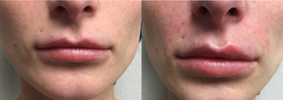 25-34 year old woman treated with Lip Augmentation - Lip Augmentation with filler - 1cc of Juvederm Ultra Plus