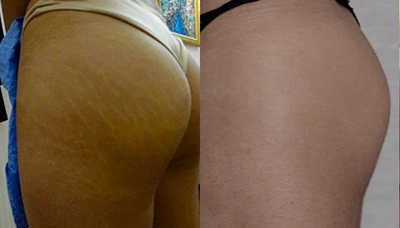 35-44 year old woman treated with Stretch Marks Treatment - Stretch Marks treated with Carboxytherapy