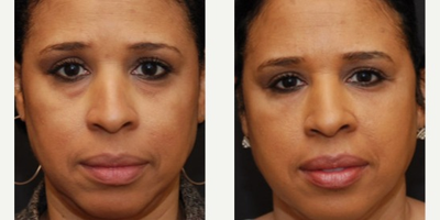 Woman treated with Restylane - Injectable Fillers to under eyes