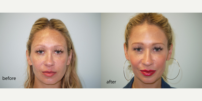 35-44 year old woman treated with Vampire Facelift - PRP whole face