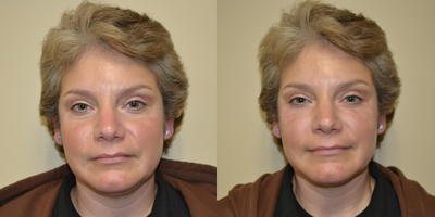 35-44 year old woman treated with ArteFill - 44 year old female received ArteFill to infraorbicular area