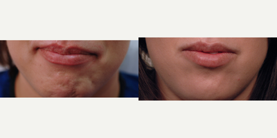Dysport (Botox) for a pebble (dimpled) chin. - This young patient had concerns about the way her chin looked.  We explained that some patients involuntarily flex the chin muscle (mentalis) when the mouth is closed and this causes the dimpling.  A quick Dysport treatment and all is smooth.