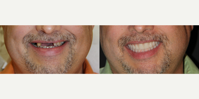 All-on-4 Dental Implants - All-on-4 Dental Implants
