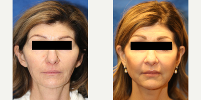 45-54 year old woman treated with Cheek Augmentation - This is a 52 year old female patient who is 510, 148 pounds.  She did not like how her face was aging.  To improve the shape and projection of her cheeks, she had cheek or malar implants inserted.  The malar implants were inserted through the mouth.  Also, to increase the width of her jaw and improve facial shape, she had angle of jaw or mandibular implants inserted.  Like the malar cheek implants, the angle of jaw or mandibular implants were inserted through the mouth.  These procedures were performed at the same time and completed under general anesthesia by Dr. J. Timothy Katzen.  These procedures took about 3 hours to complete.  Notice how much younger she looks after the insertion of cheek and mandibular implants.  Please note the change in the shape of her face.  She is very happy with her results.