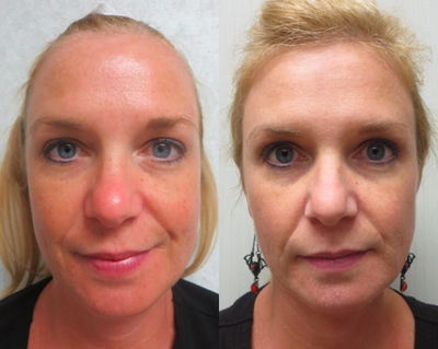 35-44 year old woman treated with BroadBand Light (BBL) - 3 weeks after 1 BBL Fotofacial Treatment