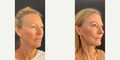 Woman treated with Eyelid Surgery - Woman treated with Eyelid Surgery as well asDeep Plane Facelift,Facial Fat Transfer,and CO2 Laser Resurfacing.