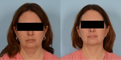 45-54 year old woman treated with Renuvion - Renuvion Neck