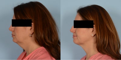 45-54 year old woman treated with Renuvion - Renuvion Neck