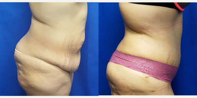 35-44 year old woman treated with Tummy Tuck - 38 year old female who is 3 months after a tummy tuck. This is her first surgery as part of her mommy makeover. She had a gastric sleeve in 2013 and lost 70 lbs. She was concerned about the loose skin and stretch marks. She has 3 children. Her preoperative height was 5 feet and 1 inch and her weight was 167 lbs. Her weight at the time of the photo was 158 lbs.