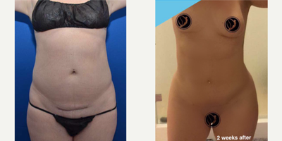 Liposculpting with Fat Transfer and C-Section Scar Revision - Before and after (patient submitted selfie) just 2 weeks after precision liposculpting with fat transfer, and cesarian section scar revision. Justin Yovino, MD FACS at Ideal Face & Body, Beverly Hills, California.