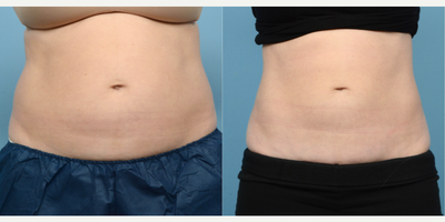 25-34 year old woman treated with Cryolipolysis - This 34-year-old patient received CoolSculpting on her upper and lower abdomen, as well as her flanks. At her 3 month follow-up visit.