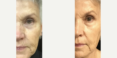 Woman treated with Opus Plasma & Laser Genesis - Resurfacing with Opus Plasma Fractionated Laser along with Laser Genesis.