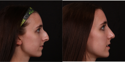 25-34 year old woman treated with Salicylic Peel - rhinoplasy