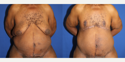 65-74 year old man treated with Gynecomastia Surgery - This patient in his early-70s was unhappy with the excess male breast tissue. The doctorperformed a male breast reduction to give him a flat chest.