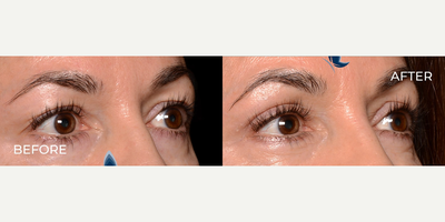 Woman treated with Eyelid Surgery - Woman treated with Eyelid Surgery