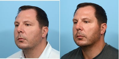 35-44 year old man treated with Chin Filler - Chin and jawline filler with Dr. Wise
