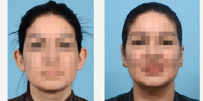 35-44 year old woman treated with Earfold - otoplasty