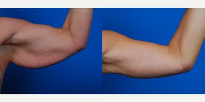 25-34 year old woman treated with Arm Lift - Bilateral Brachioplasty
