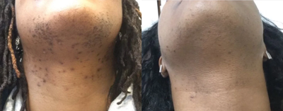 25-34 year old woman treated with Laser Hair Removal - After 4 rounds of laser hair removal 1 month apart. Pt had an excellent response after only 4 treatments. She still went on to finish the full series of 8 treatments that are typically scheduled about 4 weeks apart.