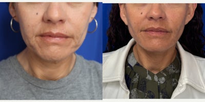 46 year old woman treated with Facelift - 46 year old woman treated with Facelift