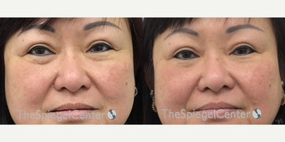 45-54 year old woman treated with AccuTite - Accutite to Upper/Lower Eyelids