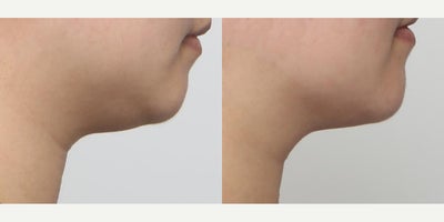 25-34 year old woman treated with Smart Lipo - She didn't like the fullness beneath her chin and wanted a smooth, tight chin profile and enhanced jawline definition. She was treated with liposuction of the chin and jowls followed by Renuvion J-Plasma skin and tissue tightening. The results are quick, natural and beautiful.