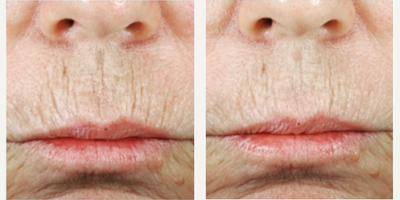 Woman treated with Lip Augmentation - Woman treated with Lip Augmentation
