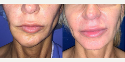 Woman treated with Chin Implant - Woman treated with Chin Implant