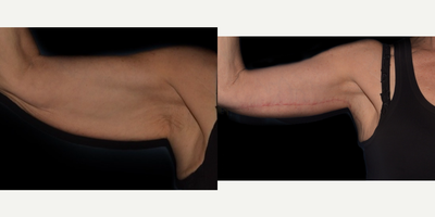 45-54 year old woman treated with Arm Lift - 1 month post op