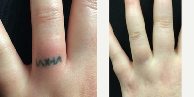 Tattoo Removal using the PicoSure Laser - Before any treatment and after a series of treatments. The patient is very happy with her results!