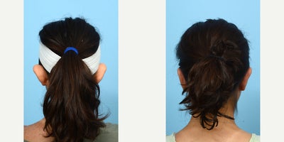 18-24 year old woman treated with Earfold - Six weeks post - otoplasty with Dr. Wise in New Jersey, this 18-year-old patient is very happy her ears no longer stick out. She also noted that the recovery was much easier than she had anticipated.