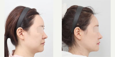 35-44 year old woman treated with Jaw Reduction, Cheekbone Reduction, Chin Liposuction, AccuLift - She had mandible jaw reduction, cheekbone reduction, genioplasty, chin liposuction and thread lifting for the neck